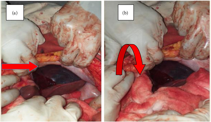 Spontaneous Hepatic Rupture Complicating Preeclampsia and HELLP Syndrome: A Case Report.