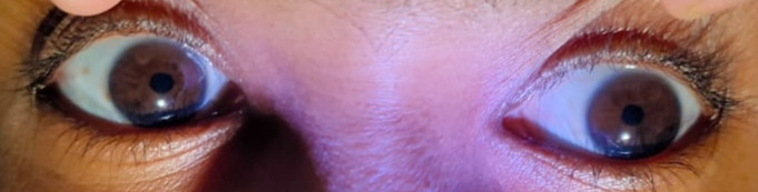 Adie's pupil and systemic manifestations: a rare unilateral presentation.