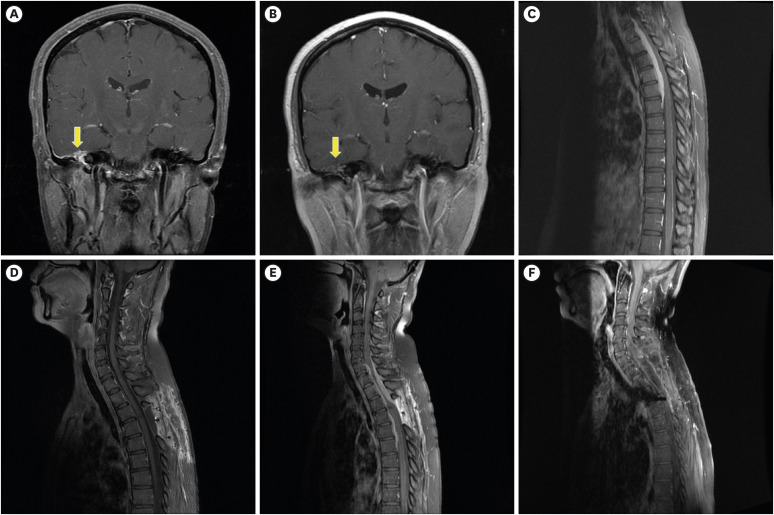 Myelopathy Due to Hypertrophic Pachymeningitis Associated With ANCA Vasculitis: A 10-Year Follow-up Case Report.