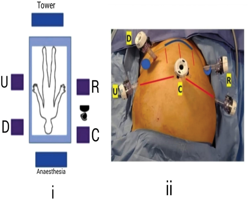 Robot-assisted radical prostatectomy with the Versius surgical platform: An objective criticism and a guide for an optimal surgical setup.