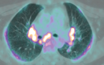 Sarcoidosis-Like Reaction in Melanoma Patients Receiving Immunotherapy or Targeted Therapy.