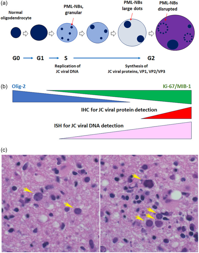 Brain biopsy and pathological diagnosis for drug-associated progressive multifocal leukoencephalopathy (PML) with inflammatory reactions.