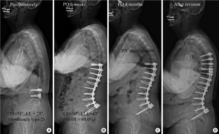 Proximal Junctional Failure Development Despite Achieving Ideal Sagittal Correction According to Age-Adjusted Alignment Target in Patients With Adult Spinal Deformity: Risk Factor Analysis of 196 Cases Undergoing Low Thoracic to Pelvic Fusion.