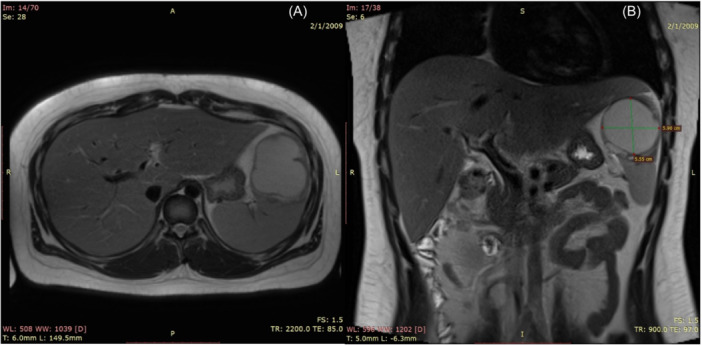 Salmonella splenic abscess.