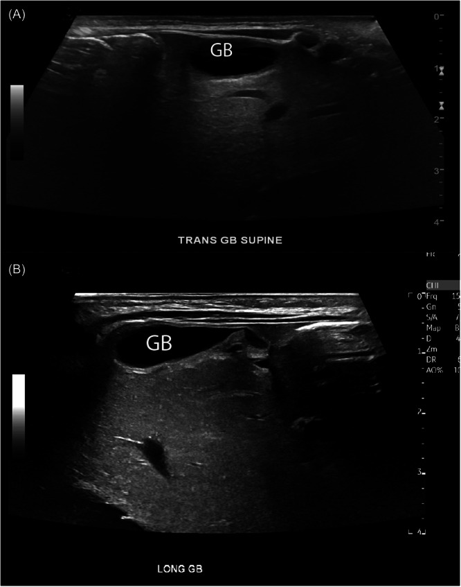 Left-sided gallbladder and Chilaiditi syndrome in an infant.