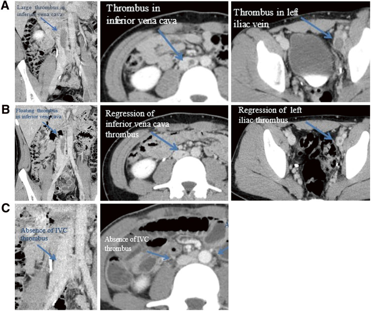 Preceding Antiphospholipid Syndrome before the Onset of Systemic Lupus Erythematosus Presenting with Iliocaval Deep Vein Thrombosis: A Case Report and Literature Review.
