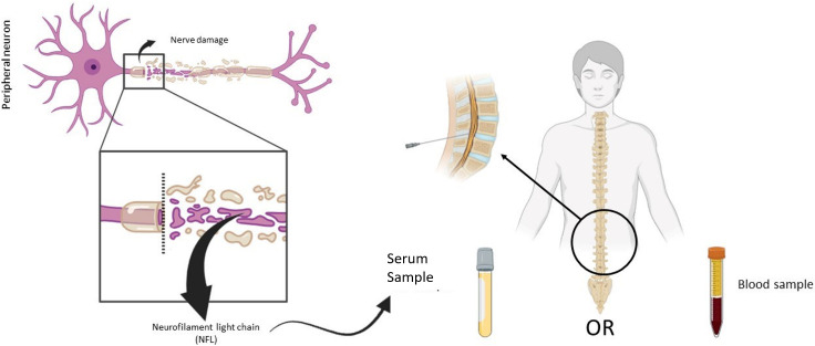 Assessment of axonal injury in multiple sclerosis: combined analysis of serum light-chain neurofilaments and diffusion tensor imaging.