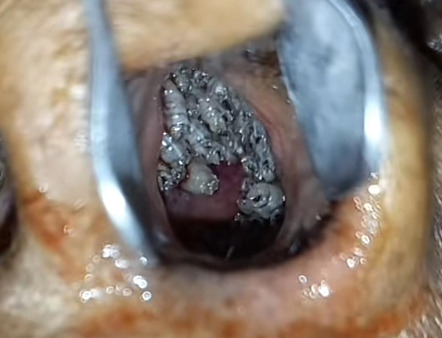 Nasal Myiasis in a Female with Christ-Siemens-Touraine Syndrome: A Case Report.