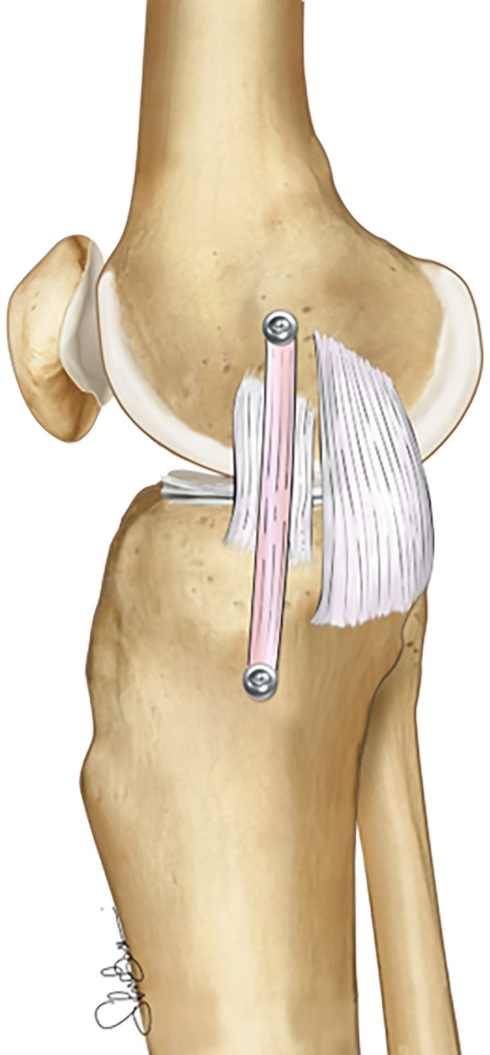Current trends in the medial side of the knee: not only medial collateral ligament (MCL).