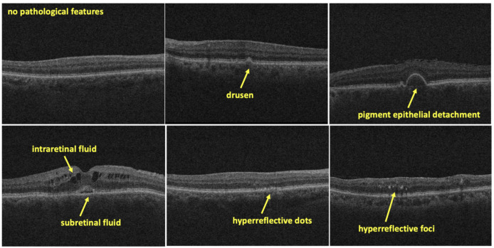 Inter-rater reliability in labeling quality and pathological features of retinal OCT scans: A customized annotation software approach.