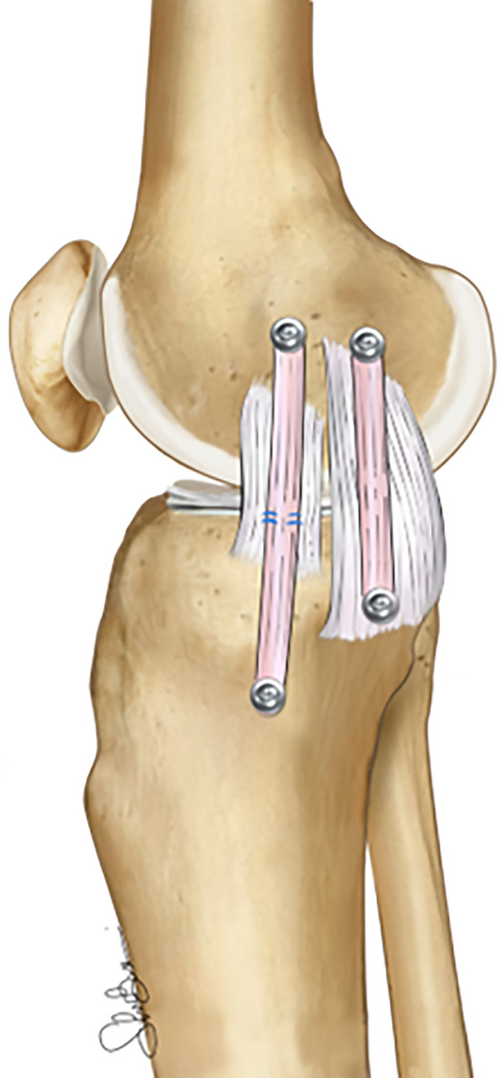 Current trends in the medial side of the knee: not only medial collateral ligament (MCL).