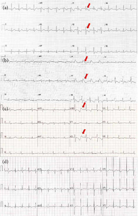 Complexities of Management of Atypical Ventricular Fibrillation Storm in a Young Patient With TANGO2.