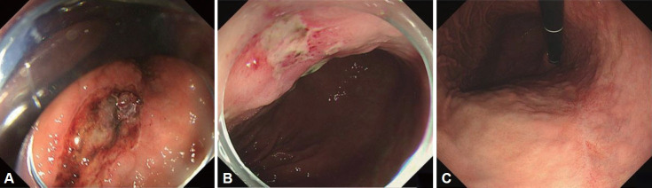 [Gastric Ulcer Bleeding Caused by Systemic Inflammatory Response to Mycobacterial Bacteremia].