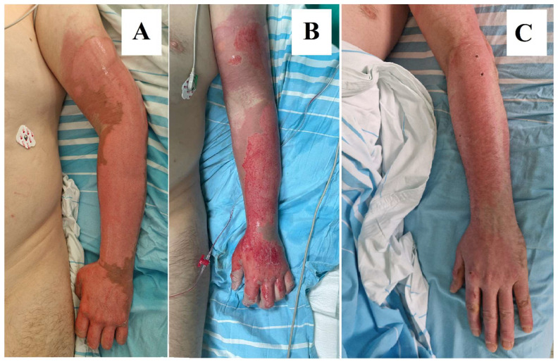 Bromelain in Burn Care: Advancements in Enzymatic Debridement and Patient Outcomes.
