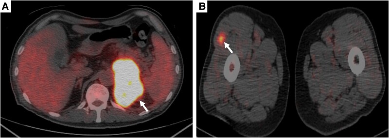 Primary Unilateral Adrenal Anaplastic Large Cell Lymphoma: Remission by Chemotherapy.