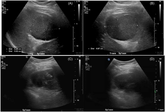 Salmonella splenic abscess.