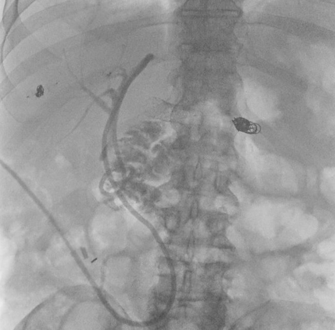 Endovascular Management of a Portal Vein Pseudoaneurysm following Pancreatoduodenectomy: A Case Report and Review of Literature.