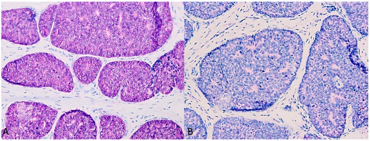 Digital Papillary Adenocarcinoma Is HPV-42-Associated and BRAFV600E Negative: Perspectives for Diagnostic Practice.
