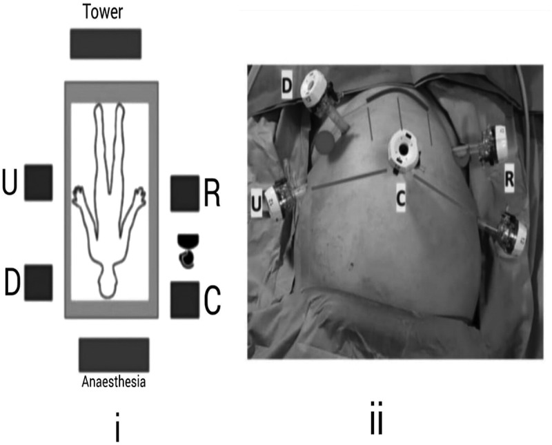 Robot-assisted radical prostatectomy with the Versius surgical platform: An objective criticism and a guide for an optimal surgical setup.