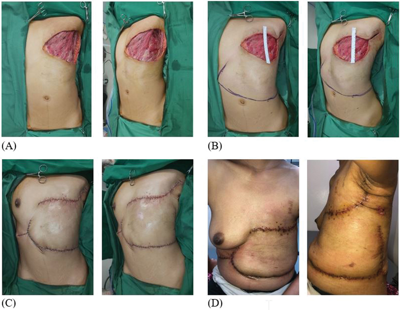 Modified Keystone a Versatile Flap Reconstruction for Mastectomy Defects: Our Clinical Experience.