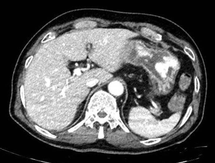 [Gastric Ulcer Bleeding Caused by Systemic Inflammatory Response to Mycobacterial Bacteremia].