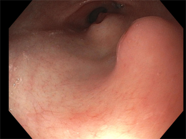 A 13-year-old with dual pancreatic rests.