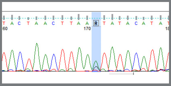 Genetic association between Class II division 1 and division 2 malocclusions with PAX9 (rs8004560) gene polymorphism in a tertiary care hospital.