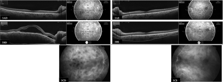 Automatic measurement of choroidal thickness with swept-source optical coherence tomography in chronic Vogt-Koyanagi-Harada disease: 3 years' follow-up.