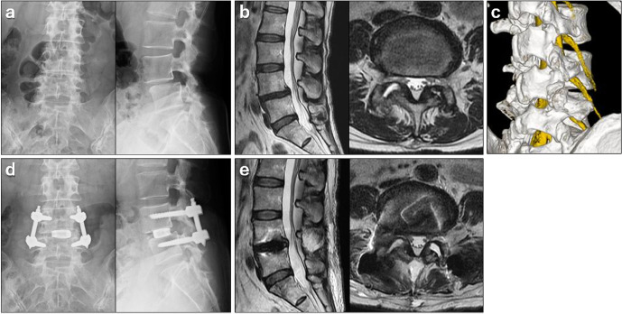 Comparative Study between Full-Endoscopic Transforaminal Approach Lumbar Interbody Fusion (TF-LIF) Using PETLIF System and Minimally Invasive TLIF for Degenerative Lumbar Spine Disorders.