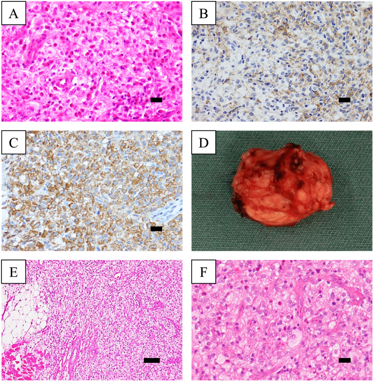 Deep juvenile xanthogranuloma invading the left tensor fasciae latae muscle: a case report and a literature review.