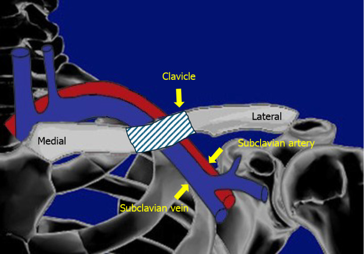 Subclavian vessels injury: An underestimated complication of clavicular fractures.