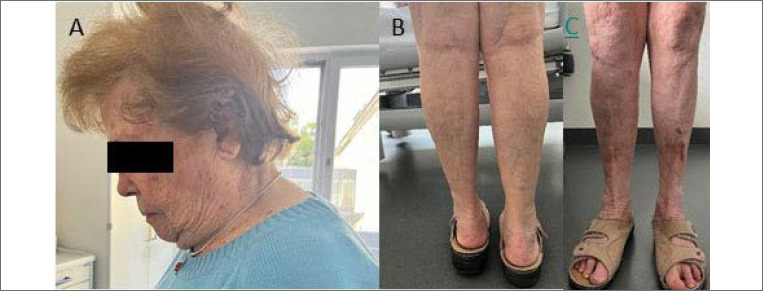 The FHL1 myopathy spectrum revisited: a literature review and report of two new patients.