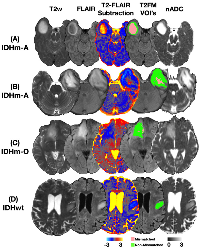 Diffusion MRI is superior to quantitative T2-FLAIR mismatch in predicting molecular subtypes of human non-enhancing gliomas.
