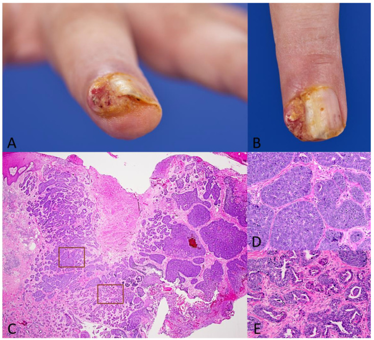 Digital Papillary Adenocarcinoma Is HPV-42-Associated and BRAFV600E Negative: Perspectives for Diagnostic Practice.
