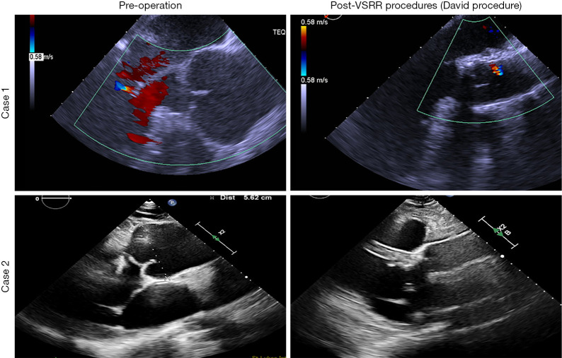 Aortopathy in repaired tetralogy of Fallot and David procedure.