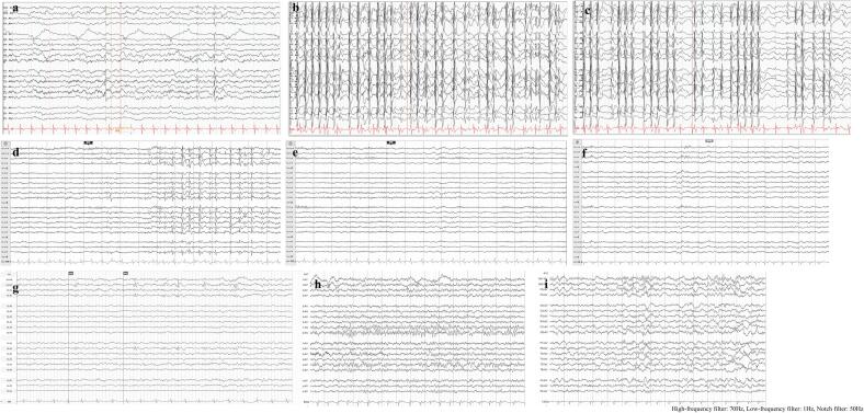Efficacy of propofol and midazolam combination in managing refractory epileptic encephalopathy with spike-wave activation in sleep