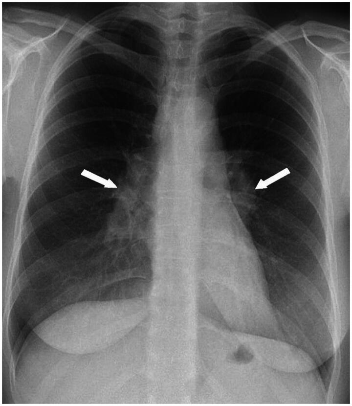 Navigating sarcoidosis: Recognizing, managing, and supporting patients in primary care.