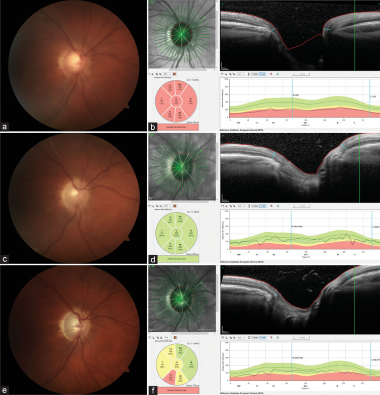 Reversal of cup-to-disc ratio following trabeculectomy using optical coherence tomography imaging: A case series.
