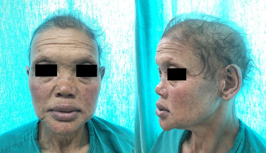 Nasal Myiasis in a Female with Christ-Siemens-Touraine Syndrome: A Case Report.