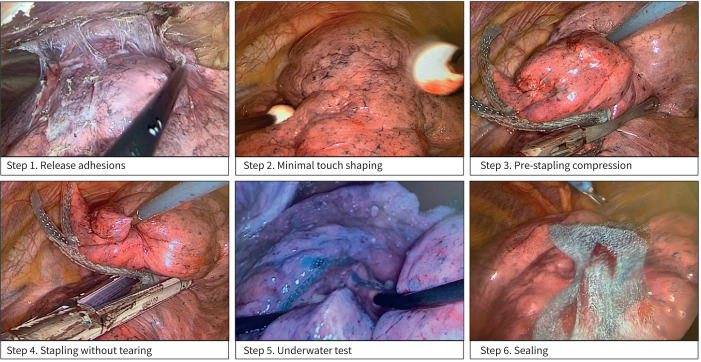 Lung volume reduction: surgery <i>versus</i> endobronchial valves.