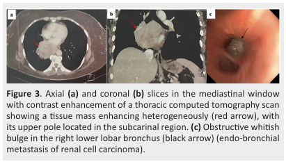 Diagnostic and therapeutic approach to endobronchial metastases from extra-thoracic neoplasms: A report of three cases and brief review of literature.