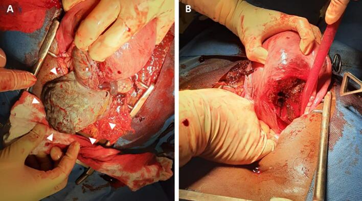 Uterine rupture with induction using misoprostol for intrauterine foetal death in the second trimester: A case report