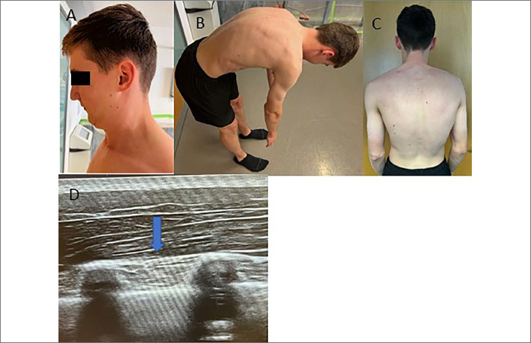 The FHL1 myopathy spectrum revisited: a literature review and report of two new patients.