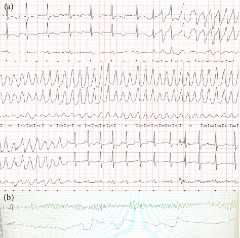 Complexities of Management of Atypical Ventricular Fibrillation Storm in a Young Patient With TANGO2.