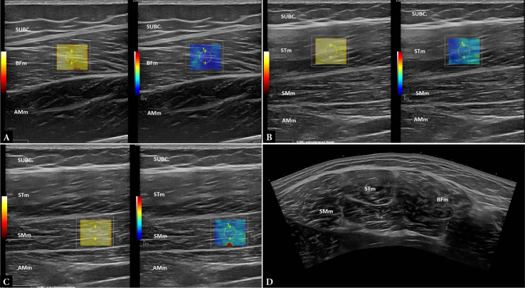 Acute effects of Nordic hamstring exercise on ultrasound shear wave elastography.