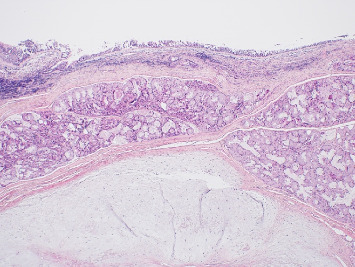 Cartilaginous Choristoma of the Oral Cavity: A Rare Presentation in the Nasopharynx.