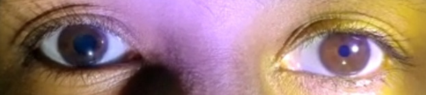 Adie's pupil and systemic manifestations: a rare unilateral presentation.