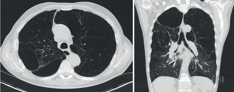 Lung volume reduction: surgery <i>versus</i> endobronchial valves.