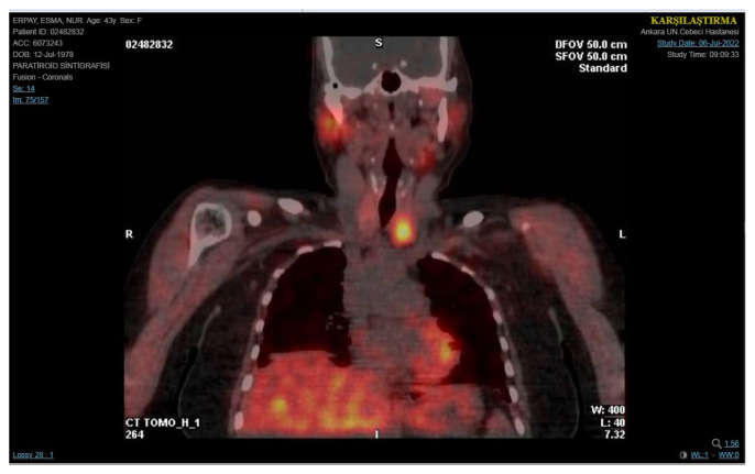 Vitamin D deficiency and surgical cellulose mimicking parathyroid adenoma after initial parathyroidectomy.