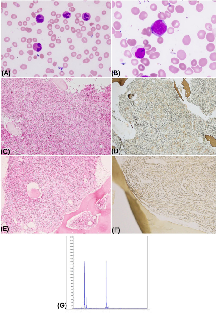Eosinophilia with <i>STAT5B</i>N642H Mutation: A Heterogeneous Entity with Overlapping Morphological Features and Poor Outcome